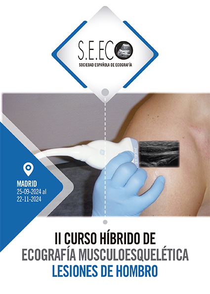 II Curso Hbrido de Ecografa Musculoesqueltica. Lesiones de Hombro
